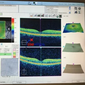 Refurbished-Carl-Zeiss-Cirrus-HD-OCT-400-Spectral-Domain